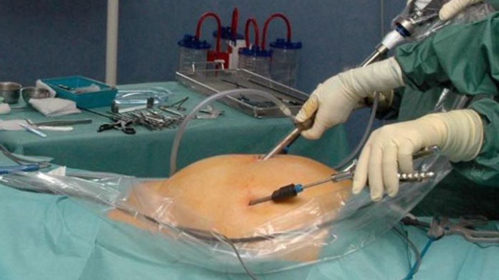La Cœlioscopie: une technique chirurgicale récente | Créa pharm